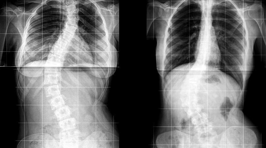 Como Identificar a Escoliose Sinais Para Observar